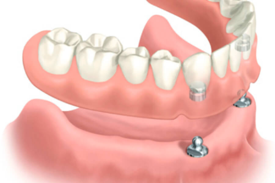 Klikprothese voor tanden tandartsbonnez terneuzen