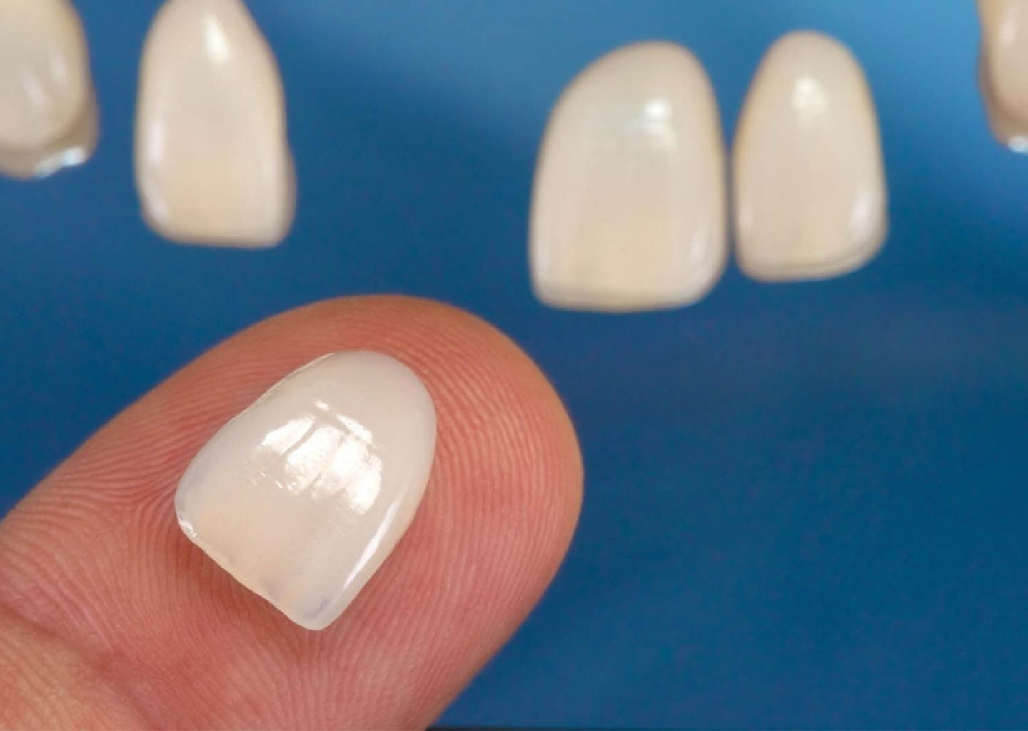 Porselein facetten voor tanden tandartsbonnez terneuzen