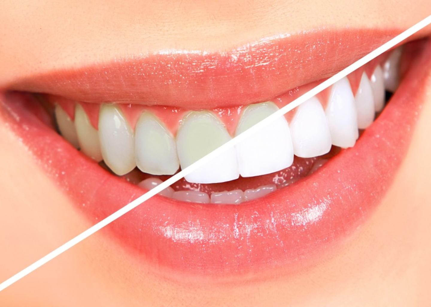 Tanden laten bleken ( bleaching ) tandartsbonnez terneuzen