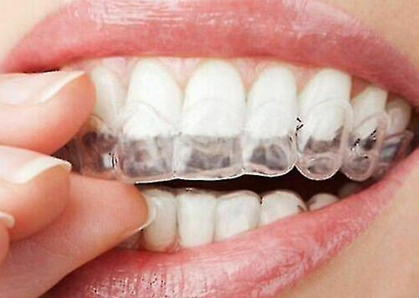 Gebitsbeschermer voor tanden tandartsbonnez terneuzen
